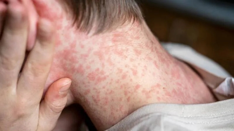 Kızamık Alarmı! Uzmanlardan Aşı Çağrısı: Vaka Artışı Şoke Etti