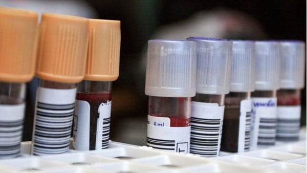 Amerika Birleşik Devletleri’nde ilk defa Alzheimer için kan testi kullanıma sunuldu